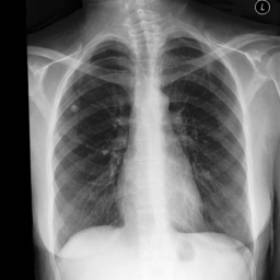虛擬胸部 X 光 CXR 範例 2